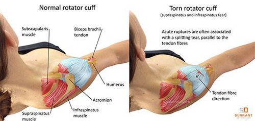 Rotator Cuff Tendinitis - Penyebab Dan Pencegahan ditarik terlalu