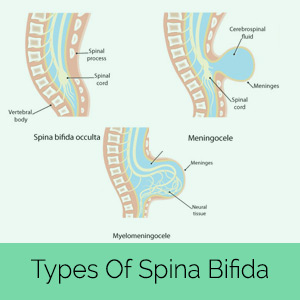 Spina Bifida Occulta: Diagnosis untuk hidup lebih lama dan